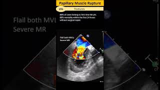 Papillary muscle rupture [upl. by Nivlad]