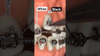 BLACK or WHITE BRACES  Orthodontics [upl. by Assilanna952]