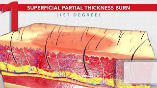 Treatment For Different Types of Burns by Burnshield [upl. by Idihsar]