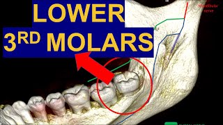 Secrets of Impacted Lower Third Molars CBCT Surgical extraction of wisdom teeth removal surgery [upl. by Chobot]