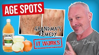 Brown AGE SPOT REMEDY Onion Juice and ACV [upl. by Yesrod]