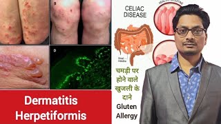 Dermatitis Herpetiformis  Celiac Disease  चमड़ी पर होने वाले खुजली के दाने  Gluten Allergy itch [upl. by Anitap]