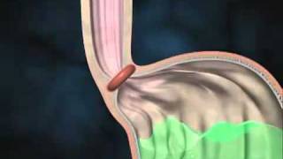 Acid Reflux Disease Causes and Symptoms [upl. by Lyrahs]