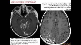 30 Meningeal enhancement pachymeninges leptomeninges subarachnoid lymphatic like membrane SLYM [upl. by Ahsikad158]