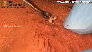 Blackheads Removal New Video by DrLalit Kasana [upl. by Htiel161]