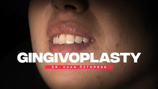 Gingivoplasty 2  Dr Kaan Öztoprak [upl. by Cibis]