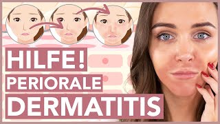 Periorale Dermatitis – So wirst Du sie los [upl. by Yessydo]