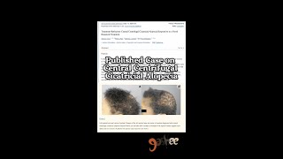 Central Centrifugal Cicatricial Alopecia Restoration [upl. by Silden]