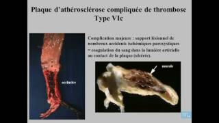 Athérosclérose Anatomie Pathologique Partie 4 [upl. by Tuck]