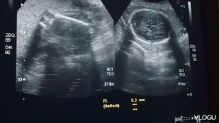 A case of fetal hydrops with oligohydramnios at 23 weeks [upl. by Mashe192]