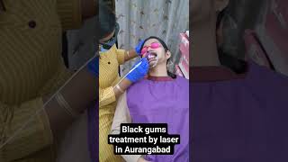 Black gum treatment by laser in Aurangabad gum depigmentation gingival bleaching melanosis treatmen [upl. by Iolanthe]