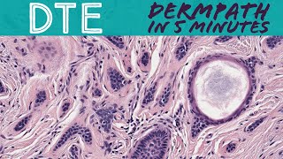 Desmoplastic Trichoepithelioma benign mimic of skin cancer BCC MAC Dermpath in 5 Minutes [upl. by Esnohpla]