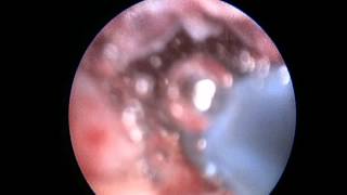 VIDEO ASSISTED FISTULA TREATMENT VAFT [upl. by Eissehc]