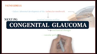 Congenital Glaucoma  ophthalmology  NEXT PG [upl. by Ahseiym]