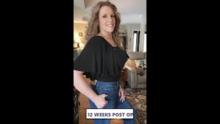 838 TUMMY TUCK Abdominoplasty amp Liposuction Surgery REAL RESULTS Dr Brian Coan 12 Week Post Op [upl. by Ellenej]