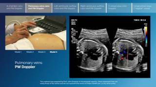 Advanced screening views of the fetal heart  Part 2  Pulmonary veins color and PW Doppler [upl. by Vera]