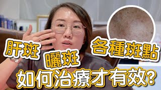 肝斑、色素不均是如何造成？來看看莊盈彥醫師治療肝斑的方式有哪些！ [upl. by Noyr]