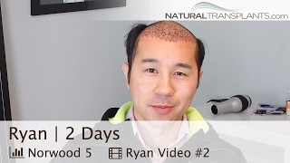 Hair Transplant Cost  Hair Transplant Alexandria Virginia  2 Day Ryan [upl. by Wojak130]