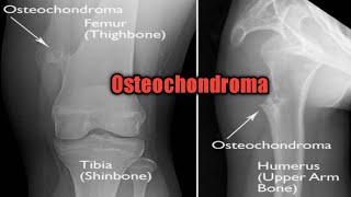 Osteochondroma  solitary and multiple pathology oncology cancer [upl. by Idahs267]