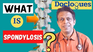 What is Spondylosis [upl. by Brig]