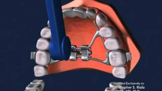 Seattle Orthodontist Dr Christopher Riolo Banded Expander RPE [upl. by Kerad201]