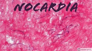 Nocardia Infection Grampositive Partially Acid Fast Aerobic Filamentous Bacteria [upl. by Vowel]