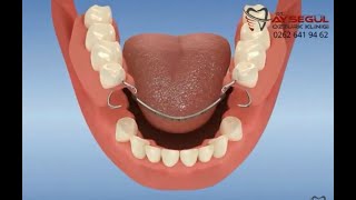 Alt çene metal iskeletli diş protezi uygulaması  takma diş [upl. by Elie135]