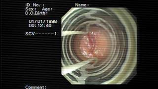 band ligation for Gastric antral vascular ectasia GAVE [upl. by Doreen485]