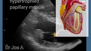 Papillary muscle hypertrophy prominent papillary muscle color Doppler echocardiography video [upl. by Auvil]