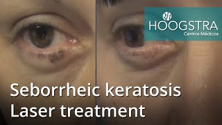 Seborrheic keratosis  Laser treatment 21021 [upl. by Ellison914]