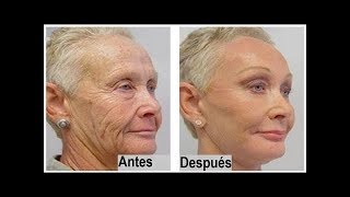 Como Eliminar la Piel flacida O Colgante de la Cara y Cuello [upl. by Eedyak]