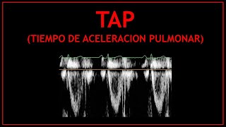 Tiempo de Aceleracion Pulmonar TAP Ecocardiografia [upl. by Kciderf415]