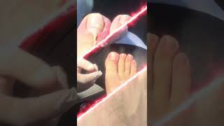 Studio podologie SOS ongle incarné 💥 ingrowntoenail nails pedicure [upl. by Nahej]