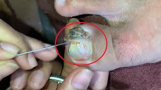 Extreme Removal Toenail  Satifying video  Cleaning Toenail [upl. by Renfred]