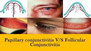 CONJUNCTIVITIS  papillae vs follicles and membranes [upl. by Aeht]