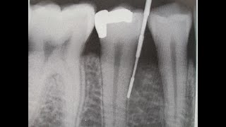 PERIODONTITIS y radiografía [upl. by Lyj]