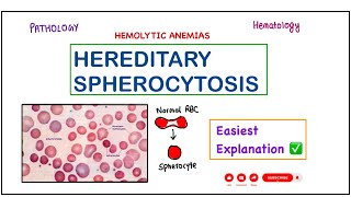 Hereditary Spherocytosis  RBC Membrane Defect  SymptomsPathophysiology Lab Diagnosis amp Treatment [upl. by Valdemar645]