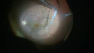 Epiretinal Membrane PeelingVitrectomy surgery Epiretinal Membran soyulmasıVitrektomi operasyonu [upl. by Piefer]