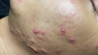 ACNE TREATMENT VU QUYNH MI Blackheads On Boy Face 2024 [upl. by Julieta]