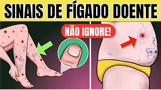 10 SINAIS de PROBLEMA no FÍGADO na PELE  Sintomas de GORDURA NO FÍGADO CIRROSE e HEPATITE [upl. by Miarzim]