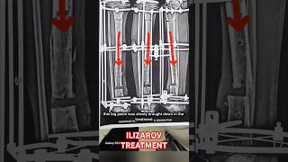 ILIZAROV TREATMENT ilizarovsurgery ytshorts [upl. by Oiram]