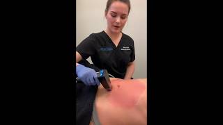 Morpheus8 Treatment to Abdomen  Dr David P Rapaport NYC [upl. by Muiram]