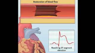 NEJM Procedure Primary PCI for Myocardial Infarction with STSegmented Elevation [upl. by Thgiwed]