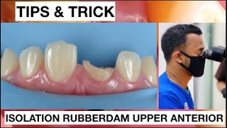 Tips and Trick Isolation With Split dam Upper Anterior Without Clamp  General Dentist Griya RR [upl. by Anilemrac]