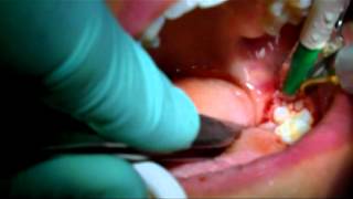 Estrazione dente giudizio incluso con piezo surgery Dr Floriano Petrone [upl. by Hcardahs]