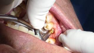 Dental Implant Healing Cap Placement Part 6  Dr John Paul Gallardo  Miami FL [upl. by Britney]