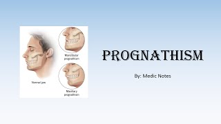 Pathophysiology of prognathism in acromegaly [upl. by Branen464]