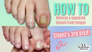 👣Pedicure How To Squeezed Toenail Journey👣 [upl. by Luebke]