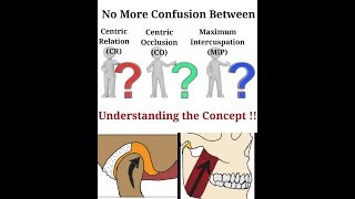 Understanding the Concept of Centric Relation Centric Occlusion Maximum Intercuspation [upl. by Anelliw806]