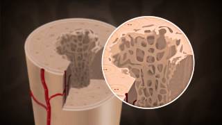 What causes Osteoporosis [upl. by Horatia927]